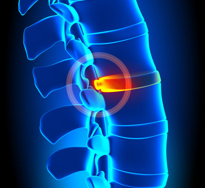 herniated disc treatment Austin TX